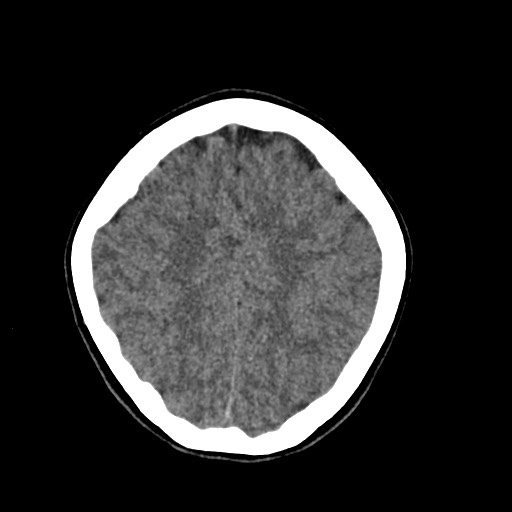 Cerebral cavernous venous malformation (Radiopaedia 70008-80022 Axial non-contrast 40).jpg