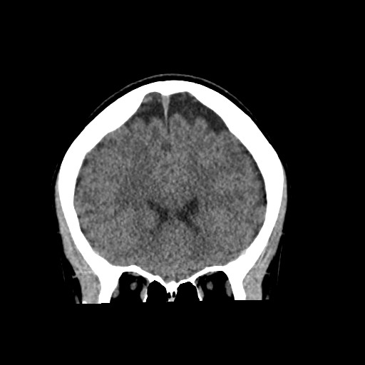 Cerebral cavernous venous malformation (Radiopaedia 70008-80022 non-contrast 22).jpg
