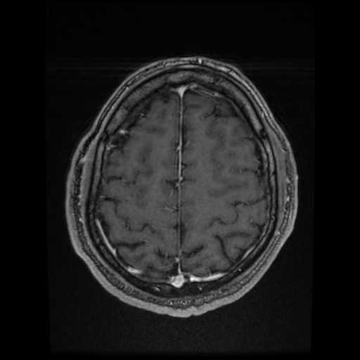 Cerebral cavernous venous malformation (Zabramski type II) (Radiopaedia 85511-101198 Axial T1 C+ fat sat 23).jpg