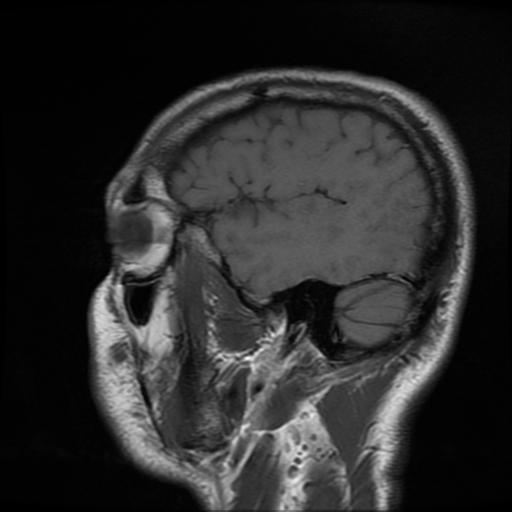 File:Cerebral cavernous venous malformation (Zabramski type II) (Radiopaedia 85511-101198 Sagittal T1 29).jpg