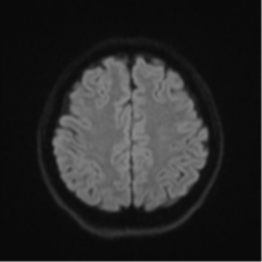 Cerebral cavernous venous malformations (Radiopaedia 48117-52946 Axial DWI 48).png