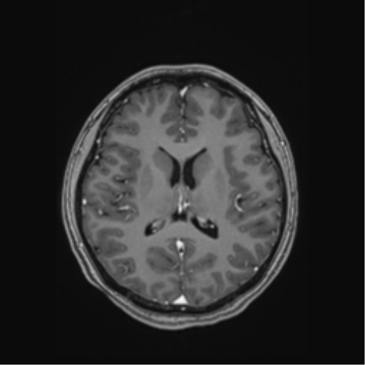 Cerebral cavernous venous malformations (Radiopaedia 48117-52946 Axial T1 C+ 35).png