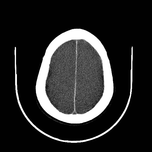 Cerebral edema (evolution in time) (Radiopaedia 19418-19439 non-contrast 75).jpg