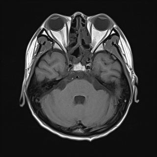 File:Cerebral embolic infarcts (embolic shower) (Radiopaedia 72391-82921 Axial T1 9).jpg
