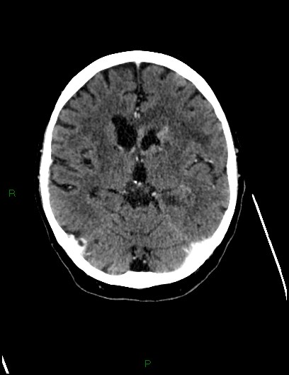 Cerebral metastases - ependymal and parenchymal (Radiopaedia 79877-93131 Axial C+ delayed 40).jpg