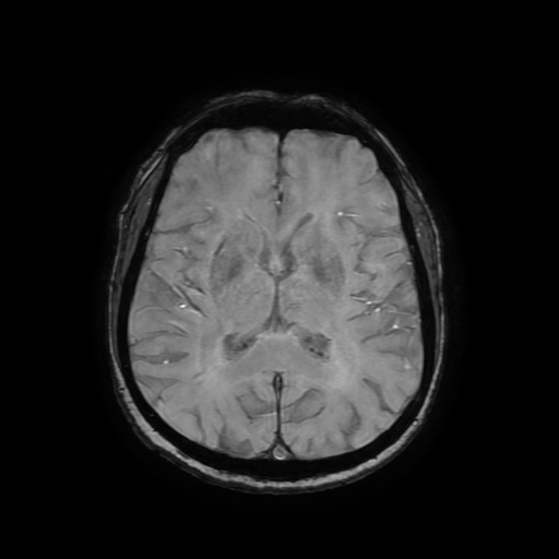 Cerebral metastases - melanoma (Radiopaedia 80972-94522 Axial SWI 55).jpg