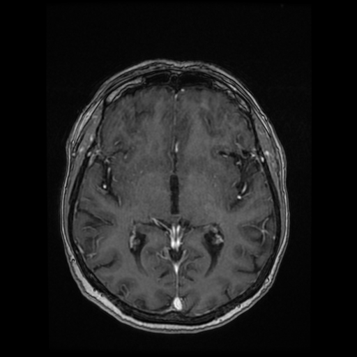 Cerebral metastases - melanoma (Radiopaedia 80972-94522 Axial T1 C+ 53).jpg
