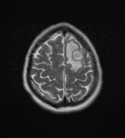 File:Cerebral metastases mimicking abscesses (Radiopaedia 45841-50131 Axial T2 24).png