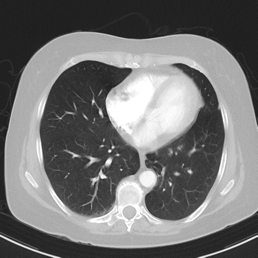 File:Cerebral metastasis mimicking glioblastoma (Radiopaedia 69155-78938 Axial lung window 30).png
