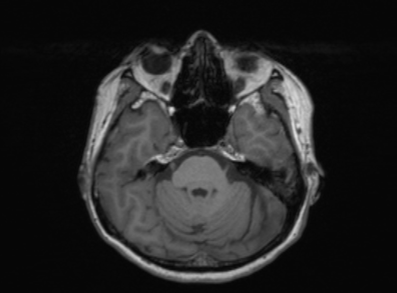 Cerebral ring enhancing lesions - cerebral metastases (Radiopaedia 44922-48817 Axial T1 286).jpg