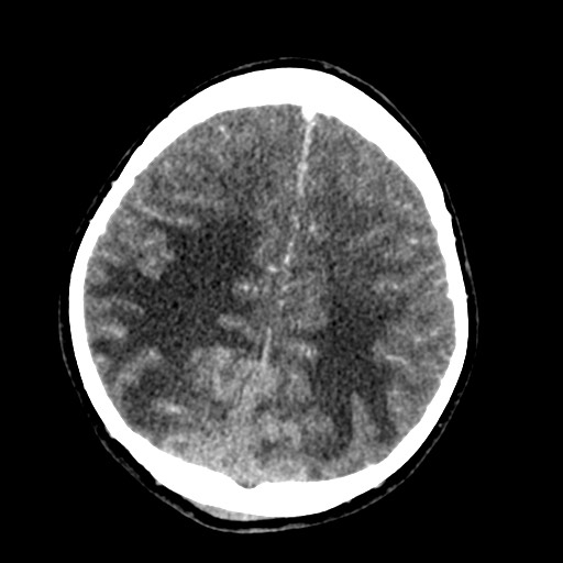 Cerebral tuberculosis with dural sinus invasion (Radiopaedia 60353-68019 Axial C+ delayed 48).jpg