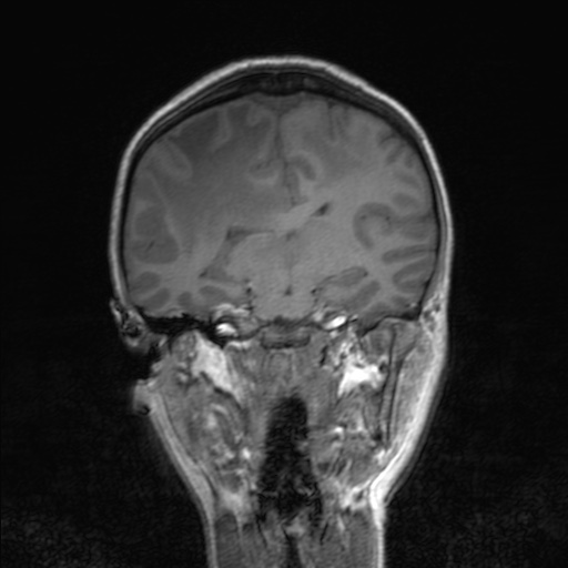 Cerebral tuberculosis with dural sinus invasion (Radiopaedia 60353-68090 Coronal T1 102).jpg