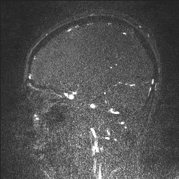 Cerebral tuberculosis with dural sinus invasion (Radiopaedia 60353-68090 Sagittal MRV 51).jpg