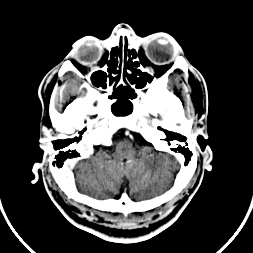 Cerebral venous angioma (Radiopaedia 69959-79977 B 2).jpg