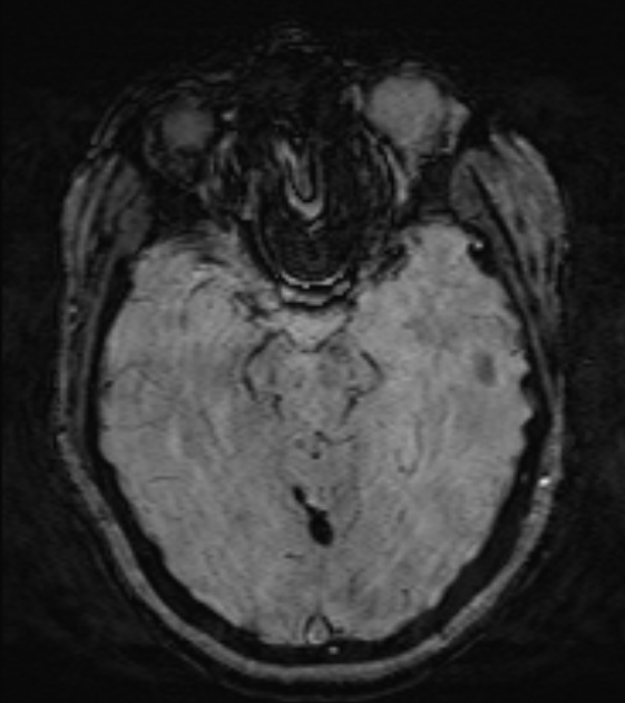 Cerebral venous infarct (Radiopaedia 53627-59685 Axial SWI 21).jpg