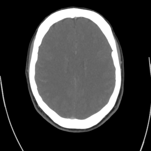 Cerebral venous infarct related to dural venous sinus thromboses (Radiopaedia 35292-36804 Axial C+ delayed 32).png