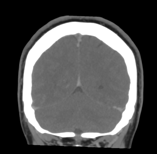 File:Cerebral venous infarct related to dural venous sinus thromboses (Radiopaedia 35292-36804 Coronal C+ delayed 47).png