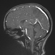 Cerebral venous infarction - hemorrhagic (Radiopaedia 81625-95505 Sagittal MRV 39).jpg
