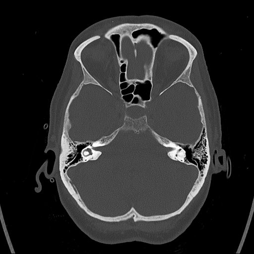 Cerebral venous infarction with hemorrhage (Radiopaedia 65343-74381 Axial bone window 32).jpg