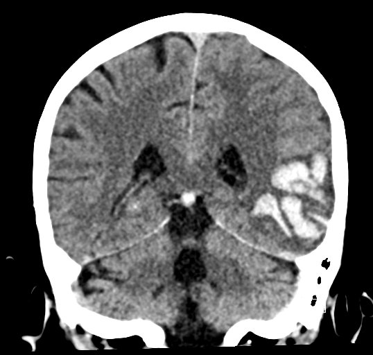 Cerebral venous infarction with hemorrhage (Radiopaedia 65343-74381 Coronal non-contrast 36).jpg