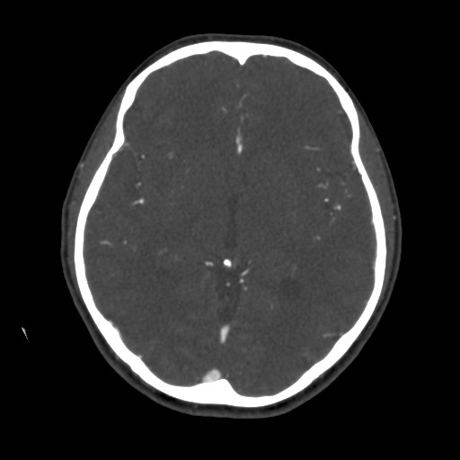 Cerebral venous sinus thrombosis (Radiopaedia 40619-43227 A 110).jpg