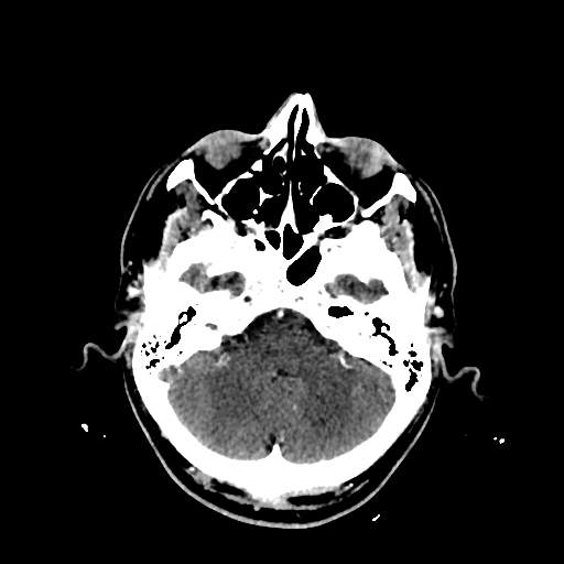 File:Cerebral venous thrombosis (CVT) (Radiopaedia 77524-89685 Axial with contrast 9).jpg