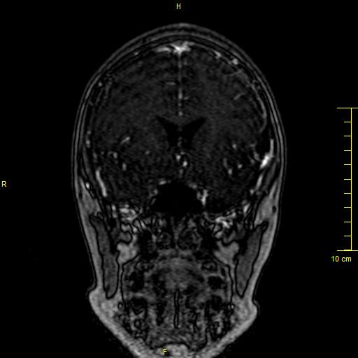 Cerebral venous thrombosis (Radiopaedia 23288-23351 MRV 39).JPG