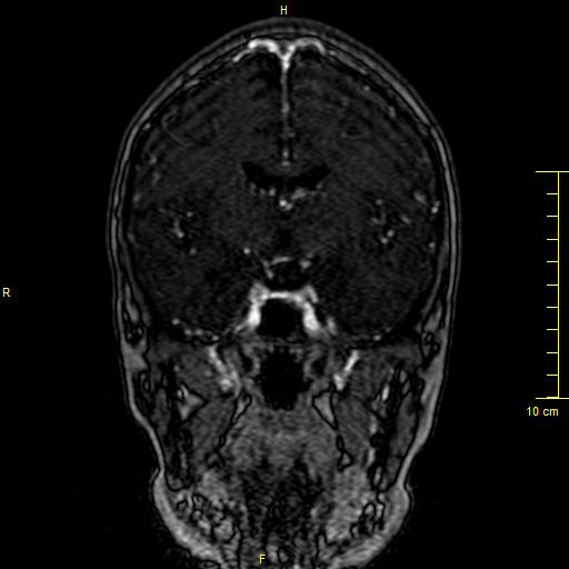 Cerebral venous thrombosis (Radiopaedia 23288-23351 MRV 65).JPG