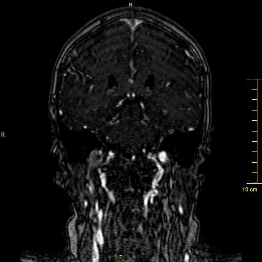 File:Cerebral venous thrombosis (Radiopaedia 23288-23351 MRV 97).JPG