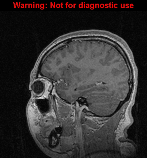 File:Cerebral venous thrombosis (Radiopaedia 37224-39208 Sagittal T1 C+ 109).jpg