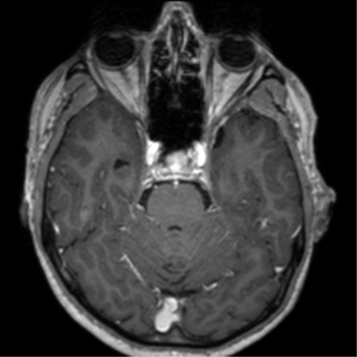 Cerebral venous thrombosis (Radiopaedia 38392-40469 Axial T1 C+ 28).png