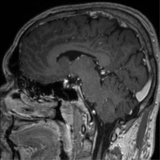 Cerebral venous thrombosis (Radiopaedia 38392-40469 Sagittal T1 C+ 49).png