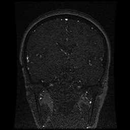 Cerebral venous thrombosis - ulcerative colitis (Radiopaedia 66049-75219 Coronal MRV 64).jpg
