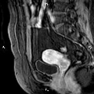 File:Cervical adenocarcinoma (Radiopaedia 65011-73985 E 13).jpg