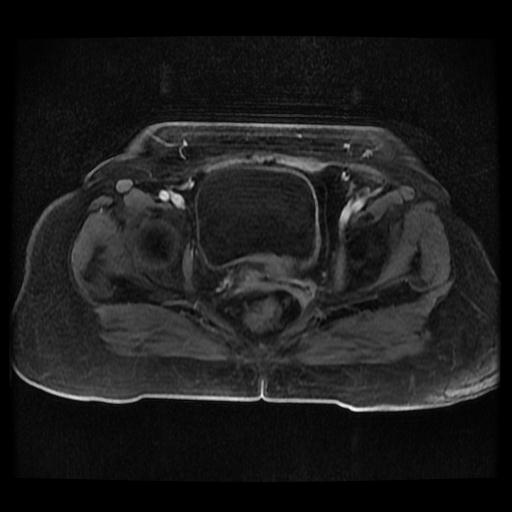 Cervical carcinoma (Radiopaedia 70924-81132 Axial T1 C+ fat sat 134).jpg