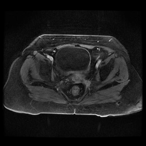 Cervical carcinoma (Radiopaedia 70924-81132 Axial T1 C+ fat sat 226).jpg