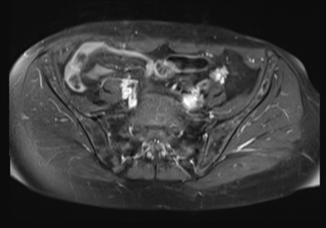File:Cervical carcinoma (Radiopaedia 88312-104943 Axial T1 C+ fat sat 6).jpg