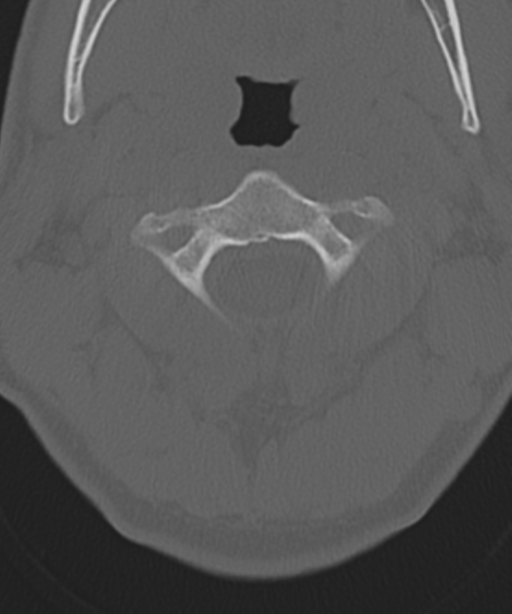Cervical intercalary bone (Radiopaedia 35211-36748 Axial bone window 19).png