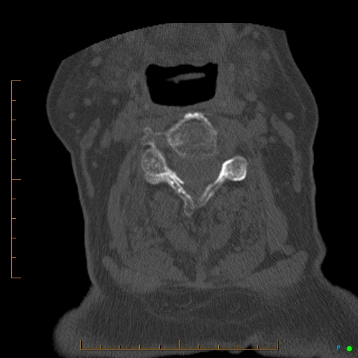 Cervical spine fracture - ankylosing spondylitis (Radiopaedia 76835-88706 Axial bone window 93).jpg