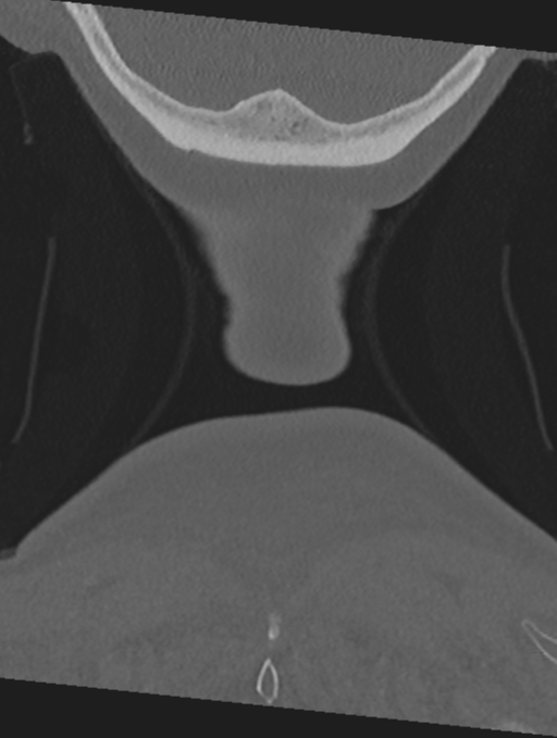 Cervical spondylolysis (Radiopaedia 49616-54811 Coronal bone window 71).png