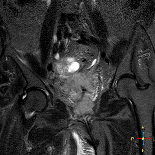 File:Cervical stump squamous cell carcinoma (Radiopaedia 48049-52858 G 5).jpg