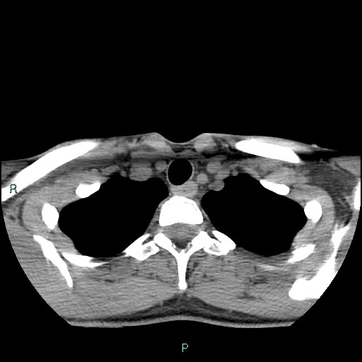 Cervical thymic cyst (Radiopaedia 88632-105335 Axial non-contrast 27).jpg