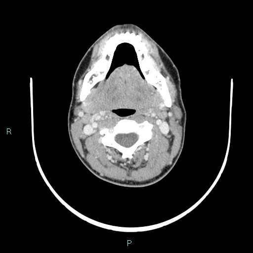 File:Cervical thymic cyst (Radiopaedia 88632-105335 C 78).jpg