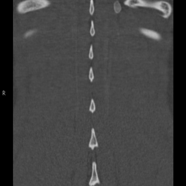Chance fracture (Radiopaedia 36521-38081 Coronal bone window 60).jpg