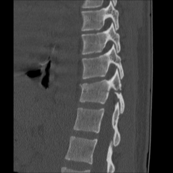 Chance fracture (Radiopaedia 36521-38081 Sagittal bone window 44).jpg