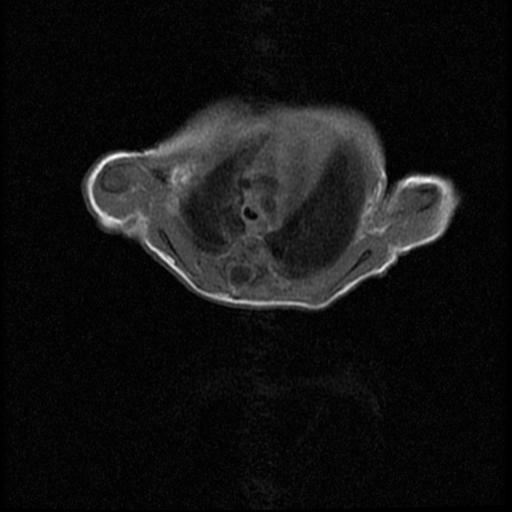 File:Chiari II malformation with spinal meningomyelocele (Radiopaedia 23550-23652 Axial T1 3).jpg