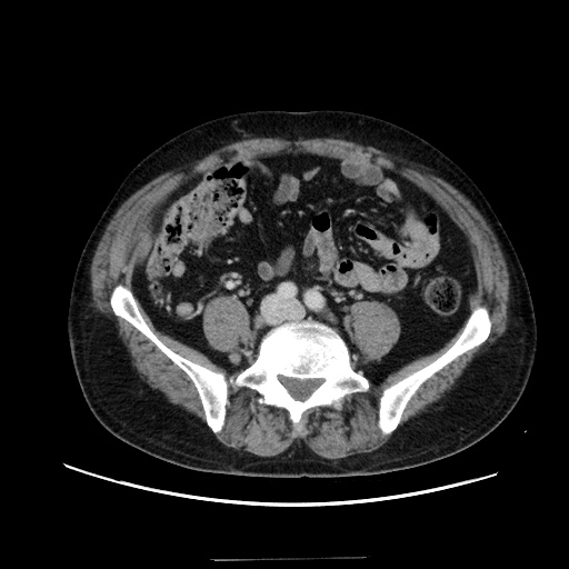Choledocholiathiasis with normal caliber common bile duct (Radiopaedia 75368-86632 A 127).jpg