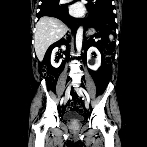 Choledocholiathiasis with normal caliber common bile duct (Radiopaedia 75368-86632 Coronal liver window 75).jpg