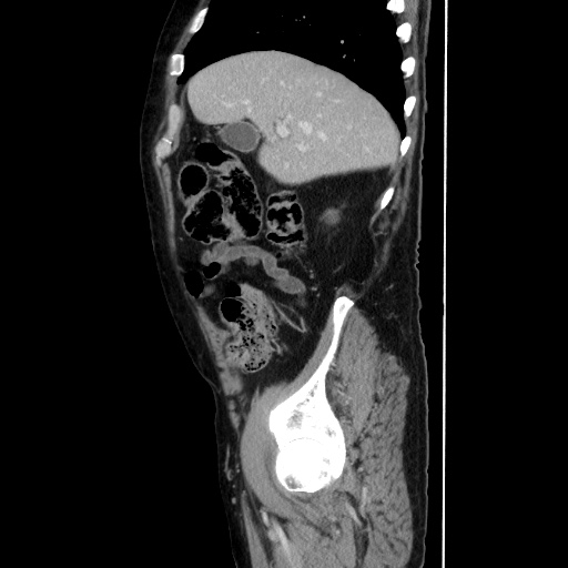 Choledocholiathiasis with normal caliber common bile duct (Radiopaedia 75368-86632 D 46).jpg