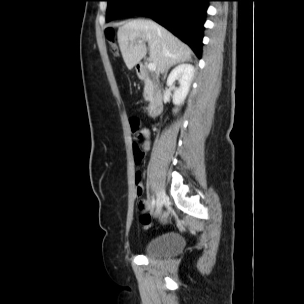 Choledocholithiasis on CT and MRI (Radiopaedia 24825-25087 D 26).jpg